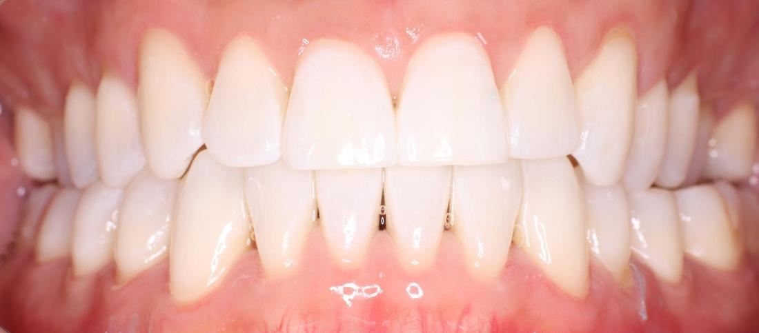 After shot of Teeth whitening in 11378