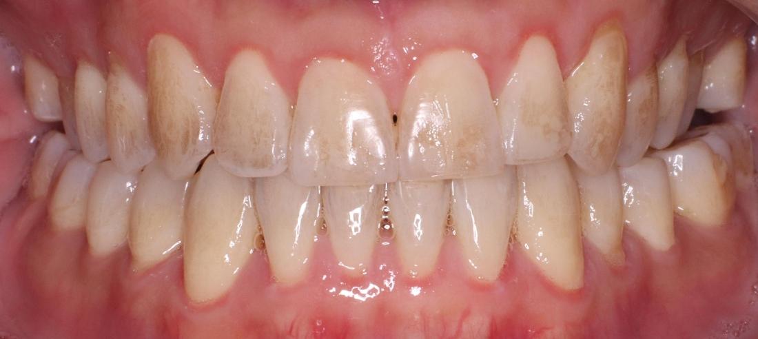 Before image of yellow teeth in 11378
