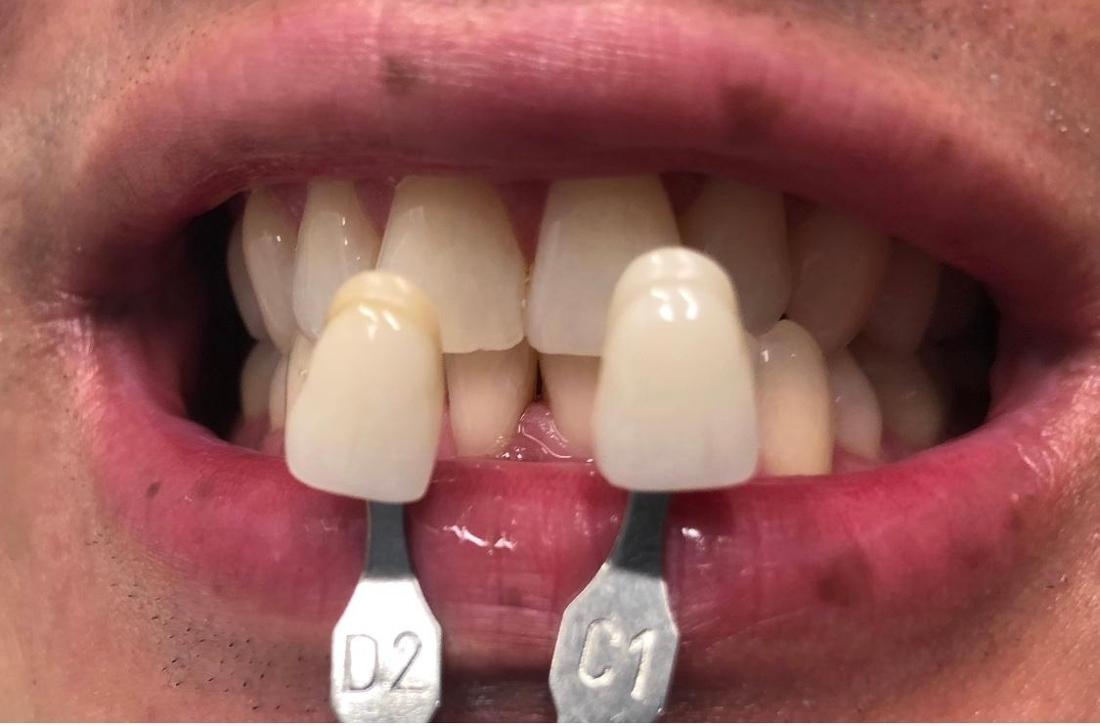 kor whitening | teeth whitening | greenwich village 