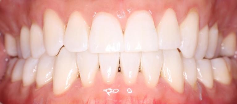 KoR-Teeth-Whitening-in-NYC-After-Image