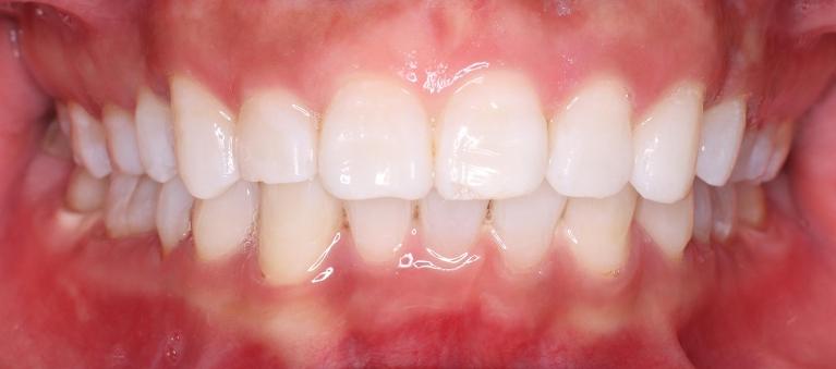 KoR-Whitening-After-Image