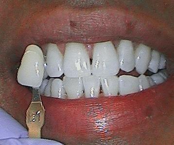 kor whitening | teeth whitening | greenwich village