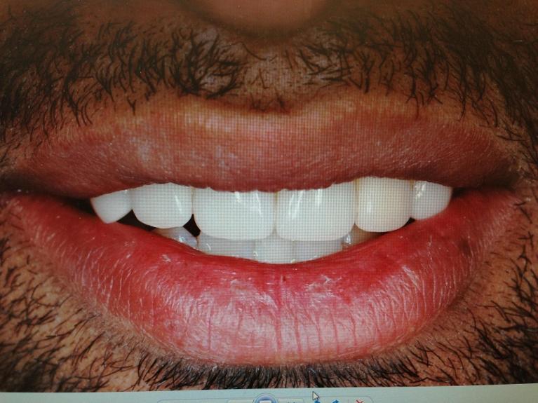 Porcelain-Veneers-After-Image