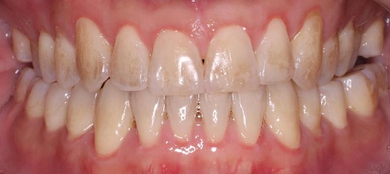 KoR-Teeth-Whitening-in-NYC-Before-Image