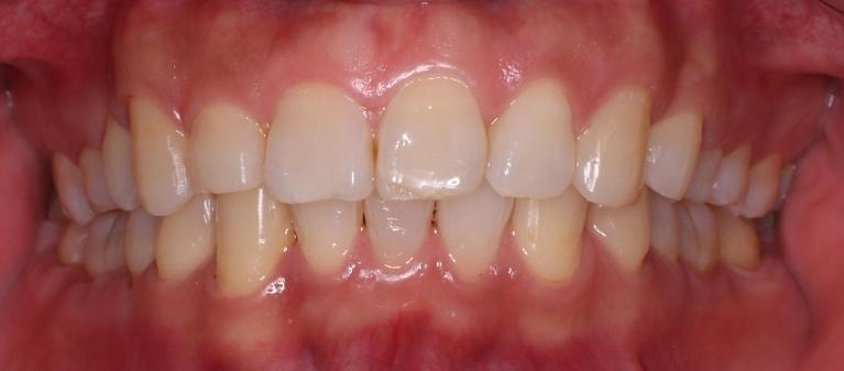 KoR-Whitening-Before-Image