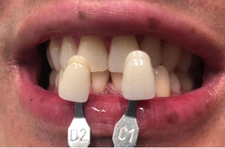 kor whitening | teeth whitening | greenwich village