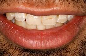 Porcelain-Veneers-Before-Image
